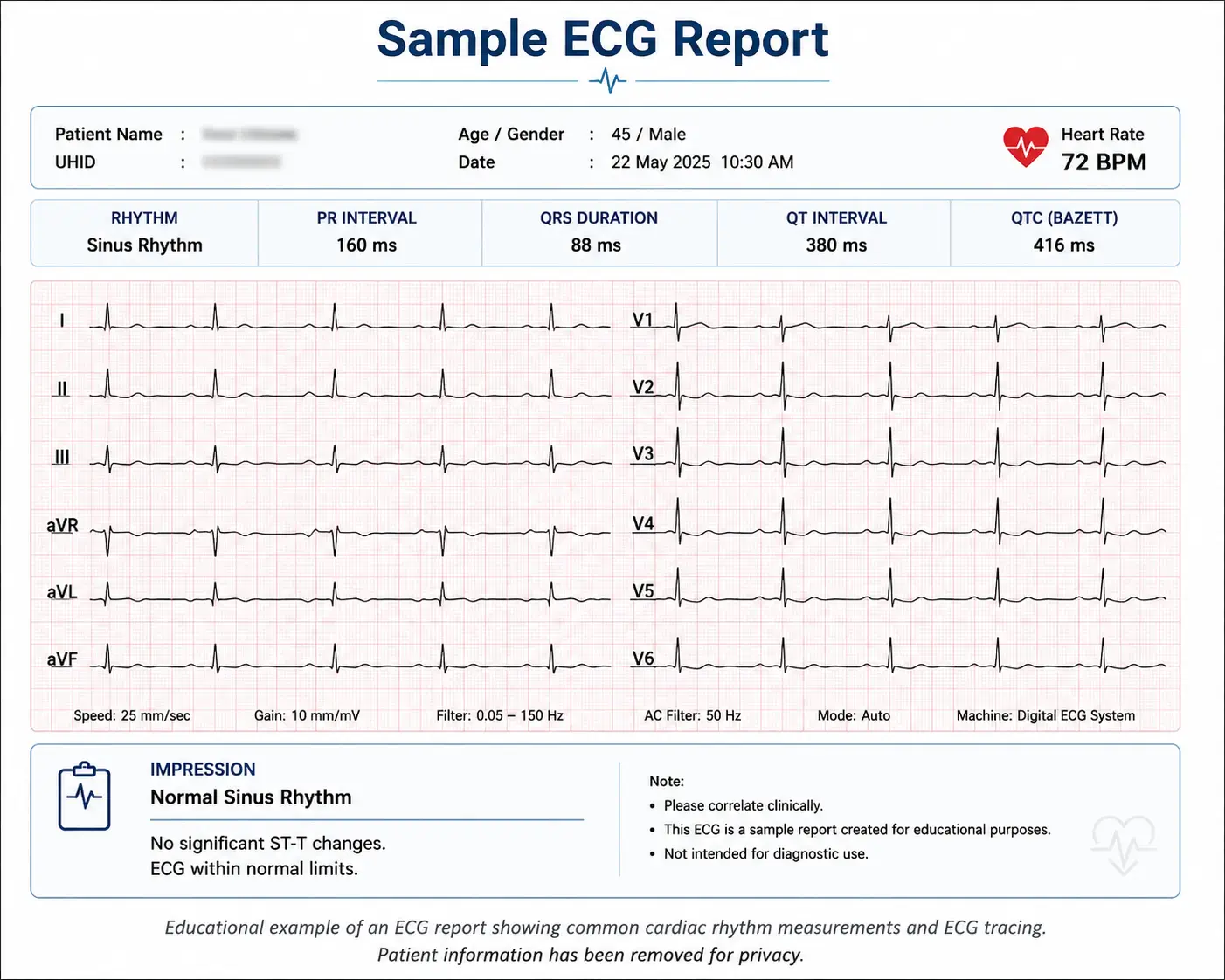 Educational example of an ECG report showing common cardiac rhythm measurements and ECG tracing. Patient information has been removed for privacy